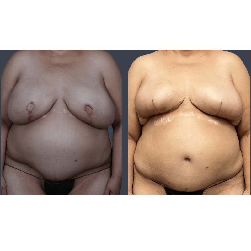 DIEP Flap Before & After Gallery - Patient 182201 - Image 2