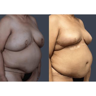 DIEP Flap Before & After Gallery - Patient 182201 - Image 4