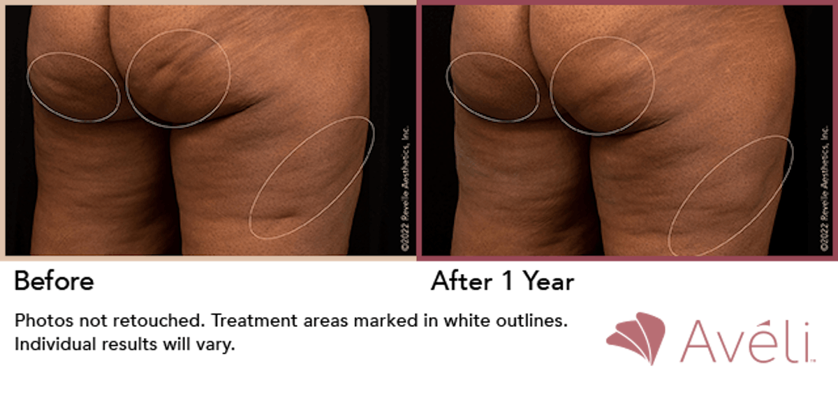 Cellulite Reduction with Avéli Before & After Gallery - Patient 950327 - Image 1