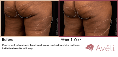 Cellulite Reduction with Avéli Before & After Gallery - Patient 950327 - Image 1