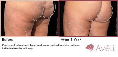 Cellulite Reduction with Avéli Before & After Gallery - Patient 190221 - Image 1