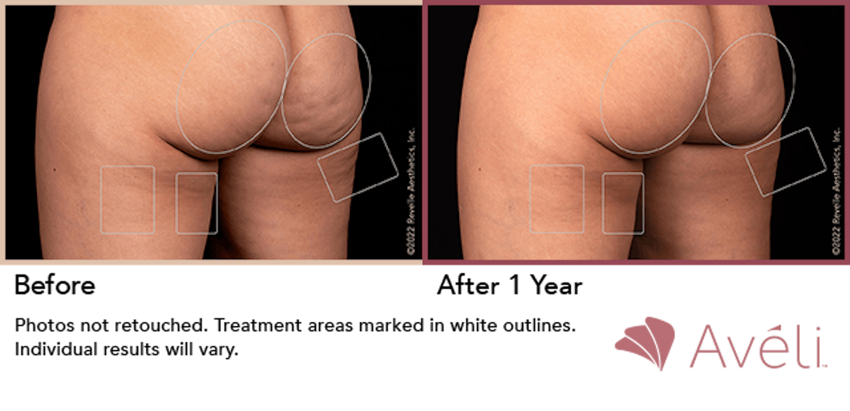 Cellulite Reduction with Avéli Before & After Gallery - Patient 110671 - Image 1
