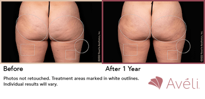 Cellulite Reduction with Avéli Before & After Gallery - Patient 165551 - Image 1