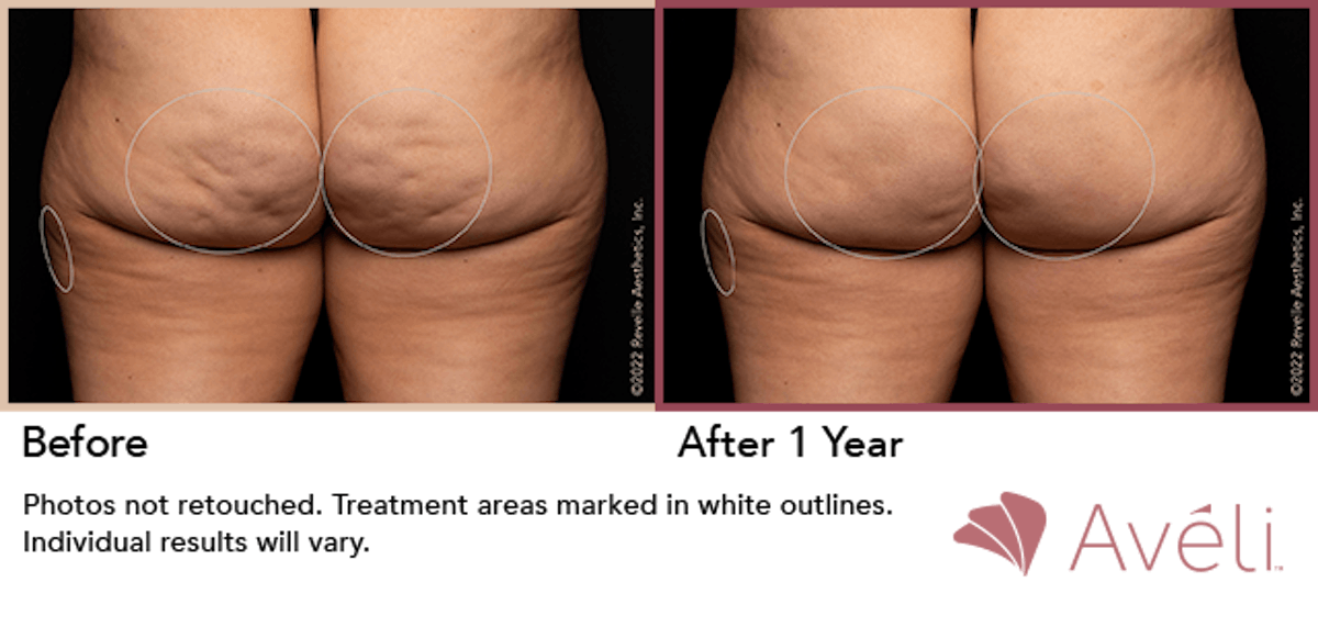 Cellulite Reduction with Avéli Before & After Gallery - Patient 387454 - Image 1