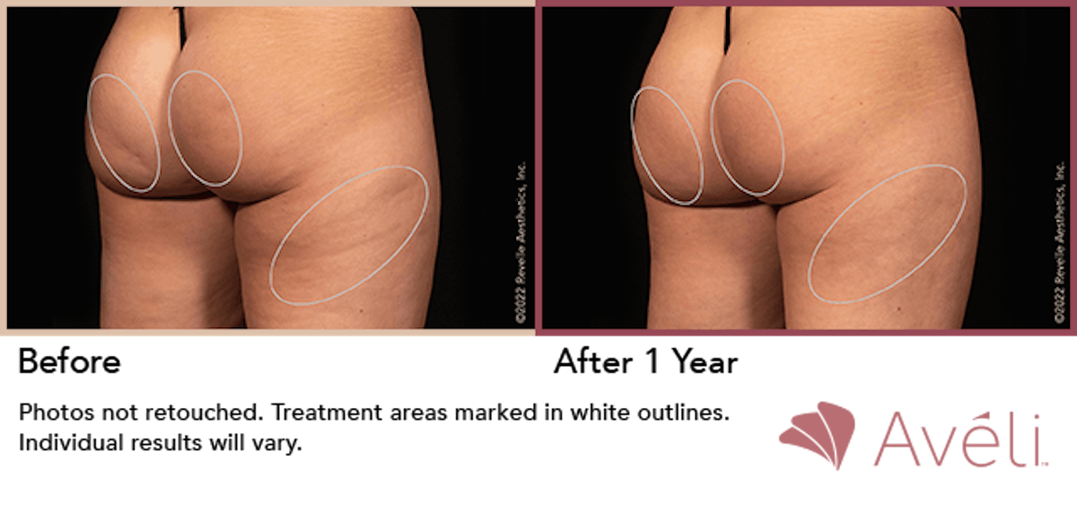 Cellulite Reduction with Avéli Before & After Gallery - Patient 298042 - Image 1