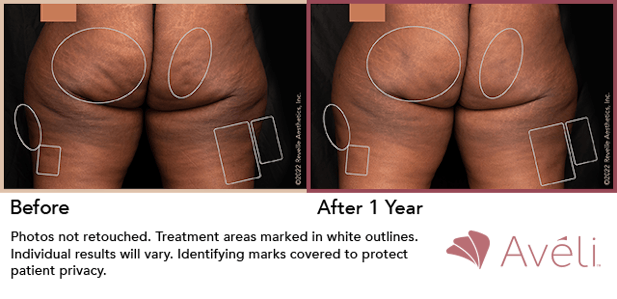 Cellulite Reduction with Avéli Before & After Gallery - Patient 579758 - Image 1