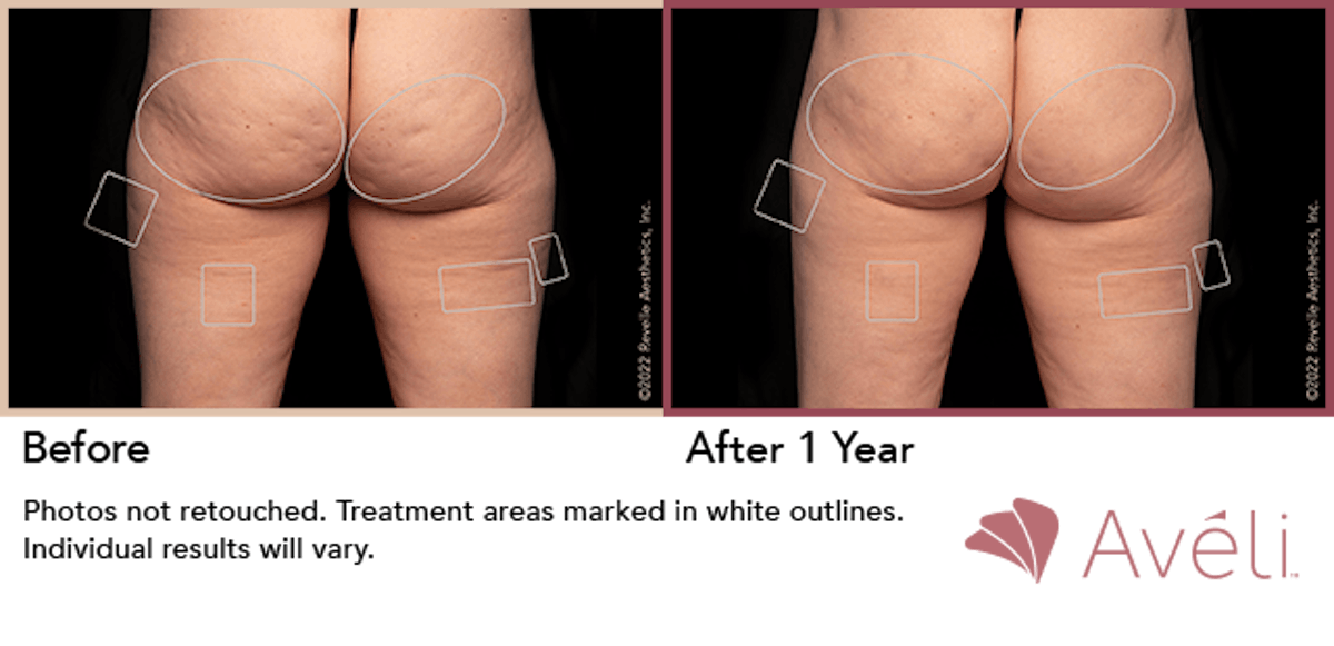 Cellulite Reduction with Avéli Before & After Gallery - Patient 314764 - Image 1