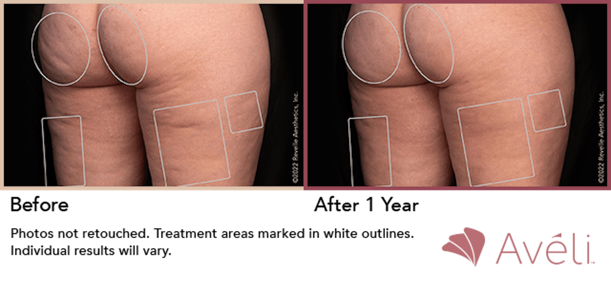 Cellulite Reduction with Avéli Before & After Gallery - Patient 270064 - Image 1