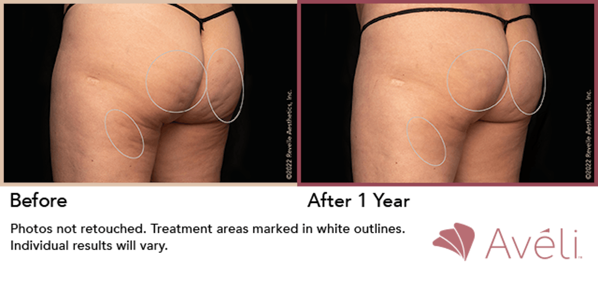 Cellulite Reduction with Avéli Before & After Gallery - Patient 409445 - Image 1