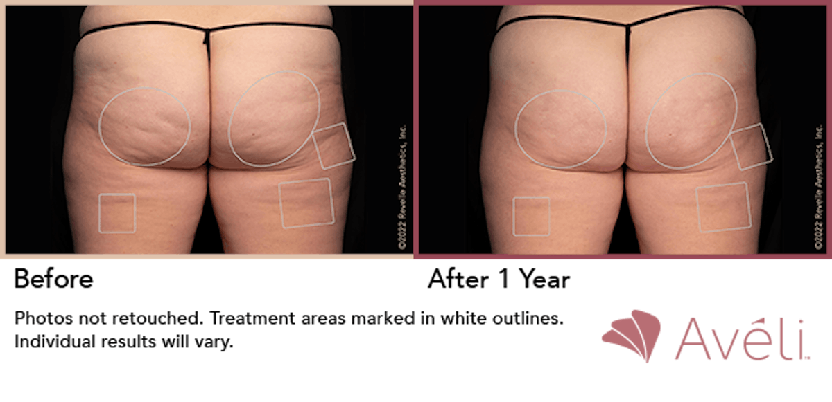 Cellulite Reduction with Avéli Before & After Gallery - Patient 321531 - Image 1