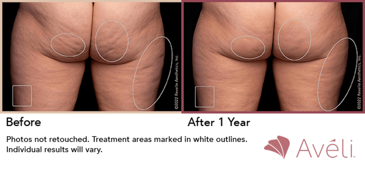 Cellulite Reduction with Avéli Before & After Gallery - Patient 147102 - Image 1