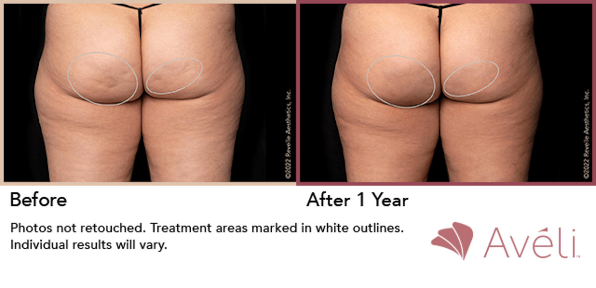 Cellulite Reduction with Avéli Before & After Gallery - Patient 195485 - Image 1