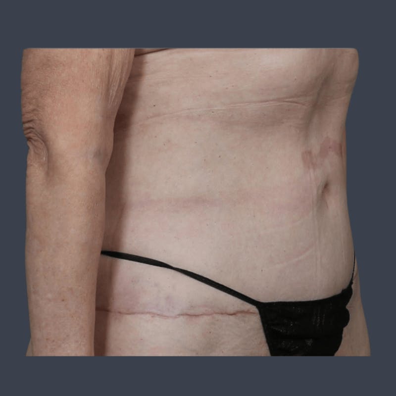 Abdominoplasty / Tummy Tuck Before & After Gallery - Patient 241742 - Image 4