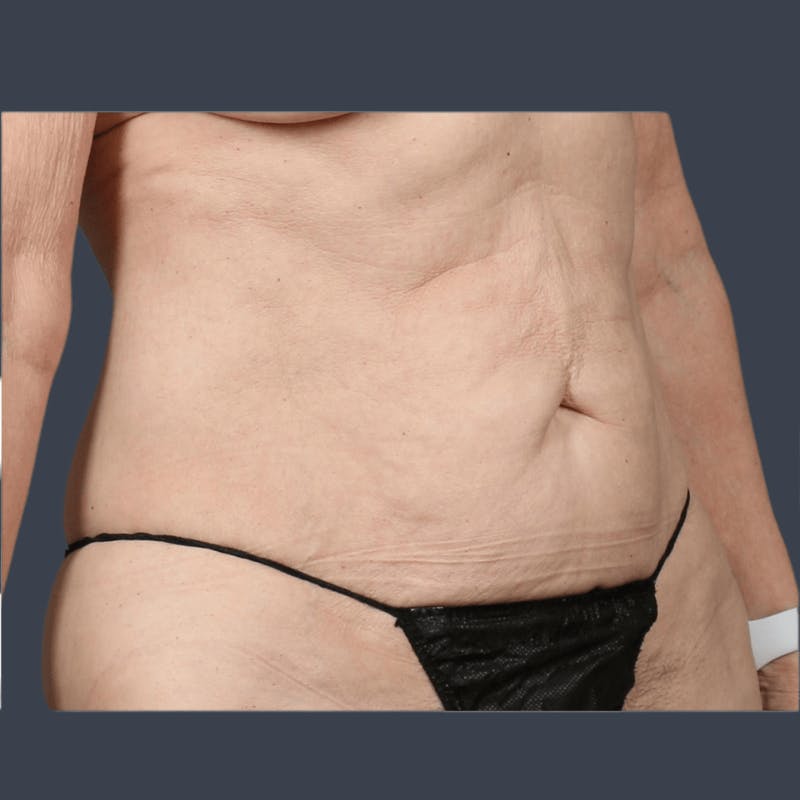 Abdominoplasty / Tummy Tuck Before & After Gallery - Patient 241742 - Image 3