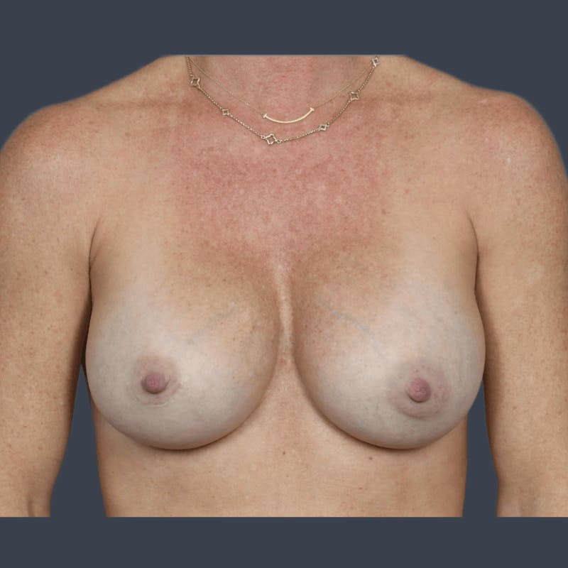 Implant Exchange Before & After Gallery - Patient 307977 - Image 2