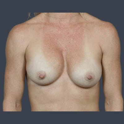 Implant Exchange Before & After Gallery - Patient 307977 - Image 1