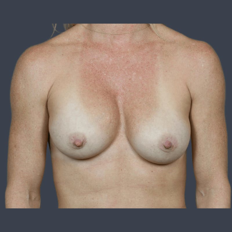 Implant Exchange Before & After Gallery - Patient 307977 - Image 1