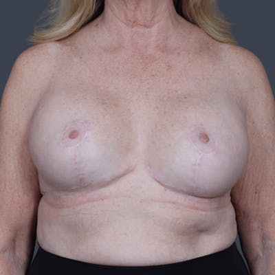 Implant Exchange Before & After Gallery - Patient 908406 - Image 2