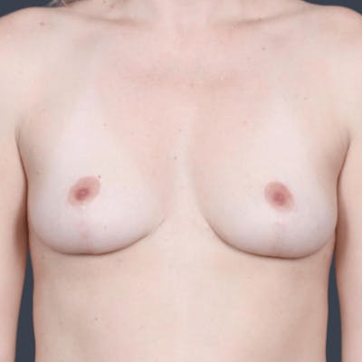 Implant Removal Before & After Gallery - Patient 144804 - Image 2