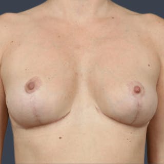 Implant Removal Before & After Gallery - Patient 307888 - Image 2