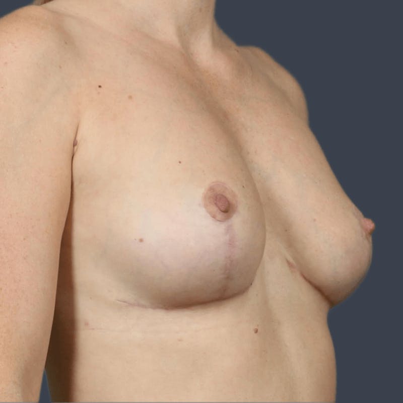 Implant Removal Before & After Gallery - Patient 307888 - Image 6