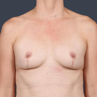 Implant Removal Before & After Gallery - Patient 119357 - Image 2