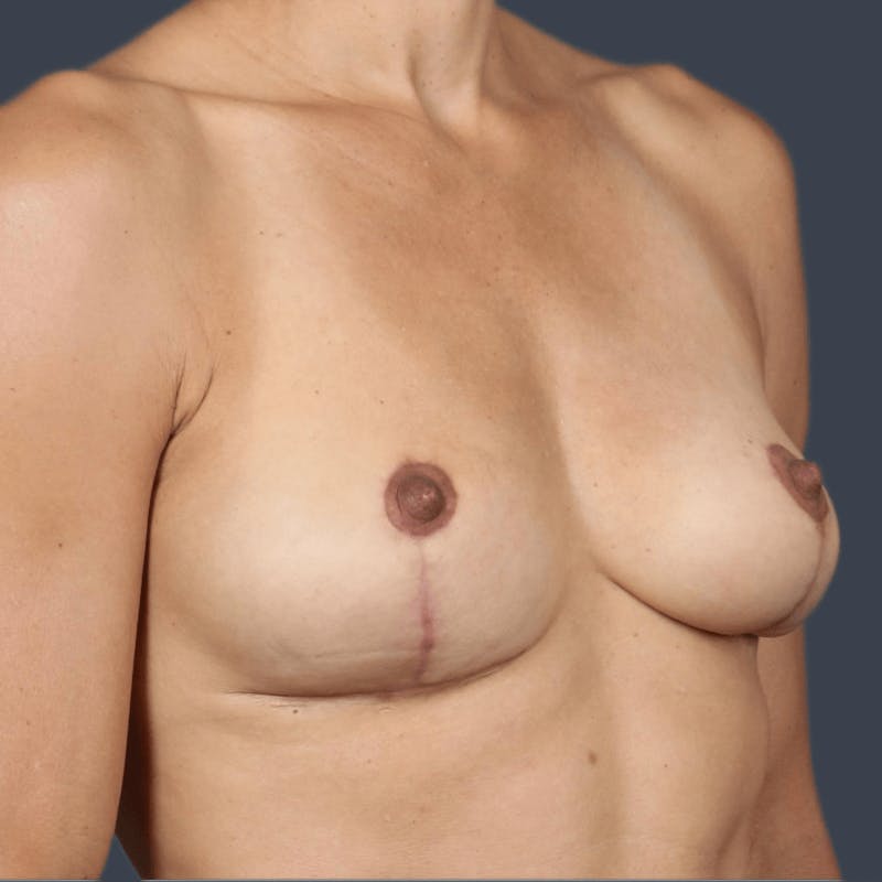Implant Removal Before & After Gallery - Patient 446804 - Image 4