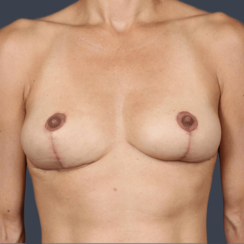 Implant Removal Before & After Gallery - Patient 446804 - Image 2