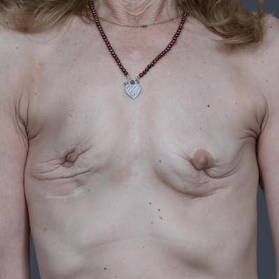 Breast Reconstruction Before & After Gallery - Patient 602112 - Image 1