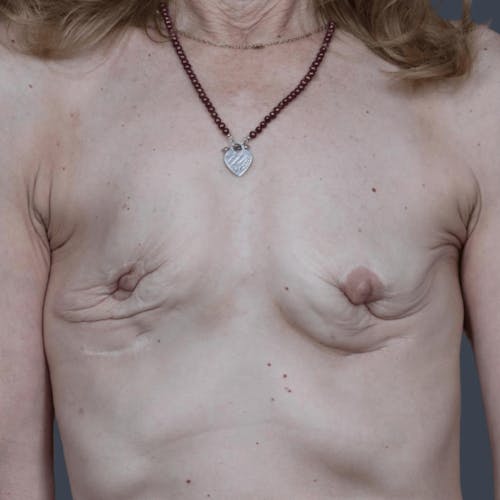 Before procedure image for Breast Reconstruction