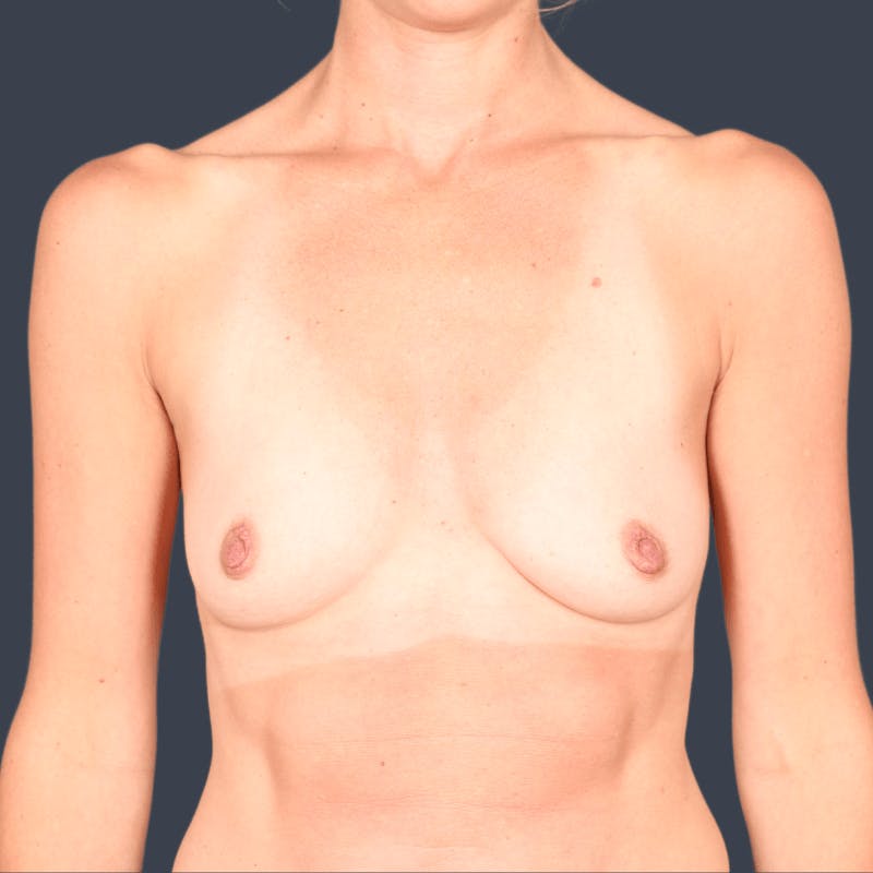 Breast Augmentation Before & After Gallery - Patient 822122 - Image 1
