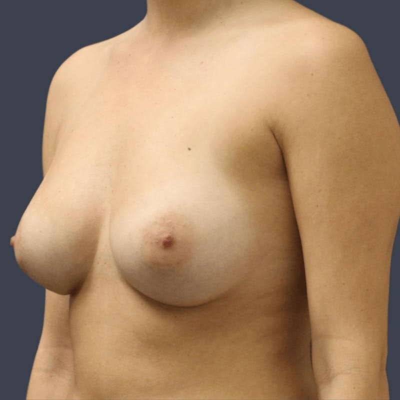 Breast Augmentation Before & After Gallery - Patient 169692 - Image 6