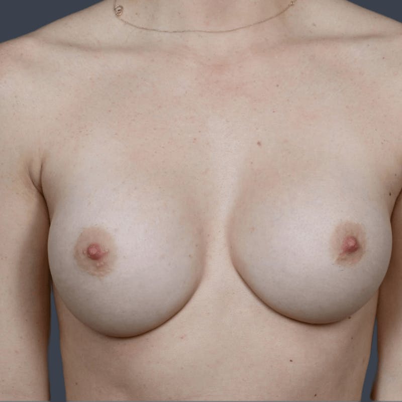 Breast Augmentation Before & After Gallery - Patient 704686 - Image 2