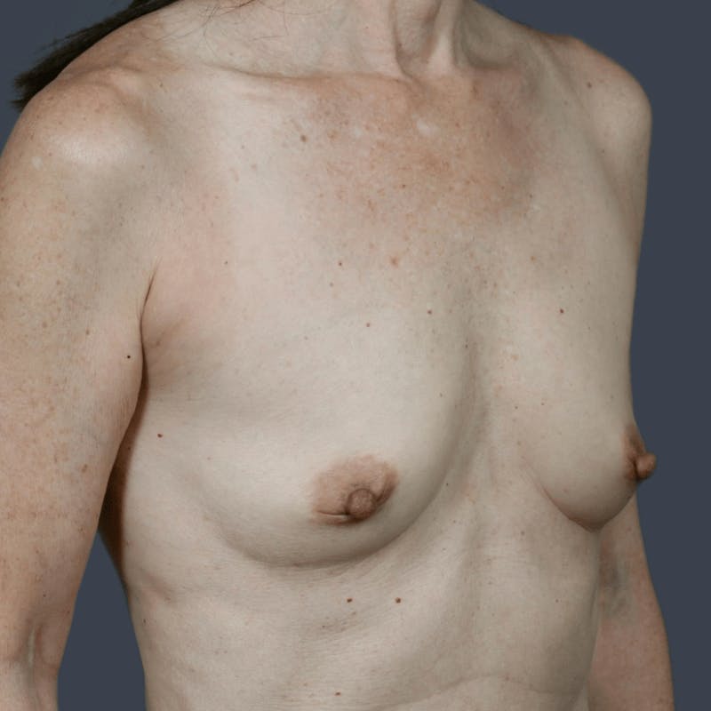 Breast Augmentation Before & After Gallery - Patient 628824 - Image 3