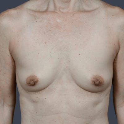 Breast Augmentation Before & After Gallery - Patient 489880 - Image 1