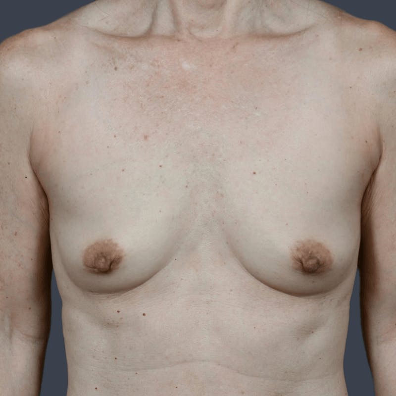 Breast Augmentation Before & After Gallery - Patient 628824 - Image 1