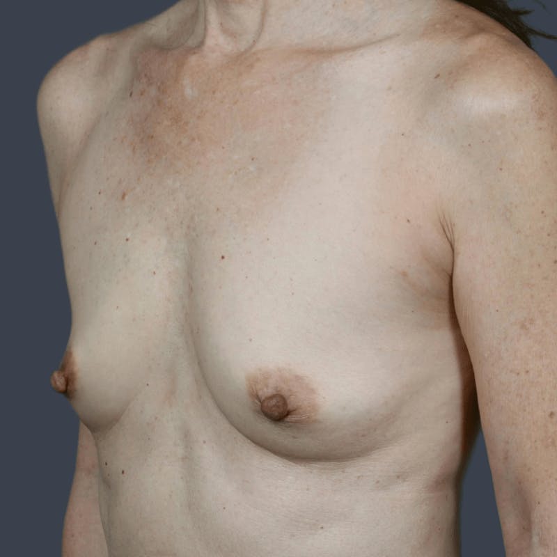 Breast Augmentation Before & After Gallery - Patient 628824 - Image 5