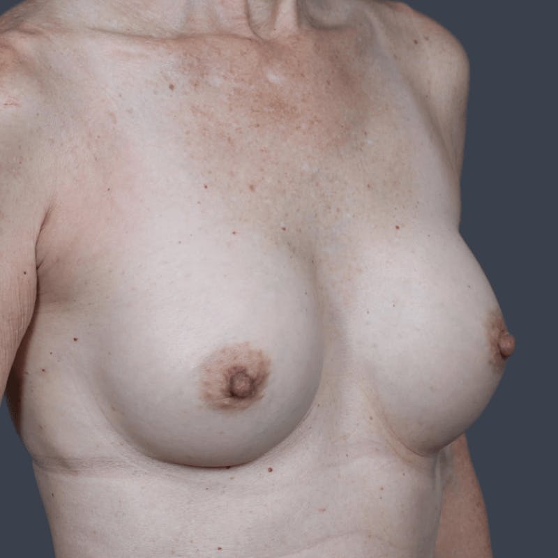 Breast Augmentation Before & After Gallery - Patient 628824 - Image 4