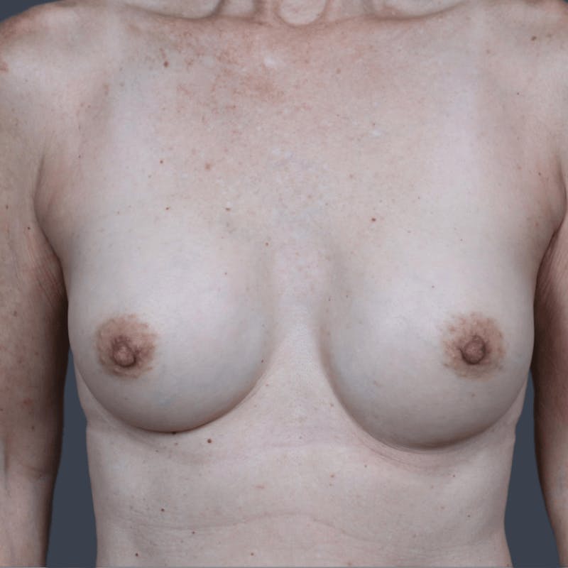 Breast Augmentation Before & After Gallery - Patient 628824 - Image 2