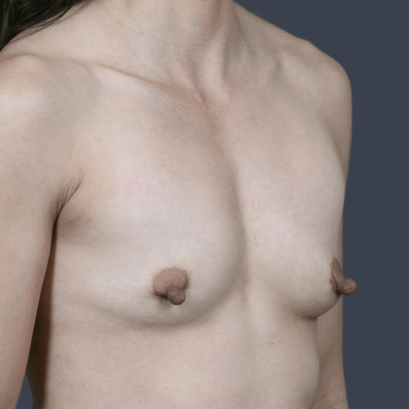 Breast Augmentation Before & After Gallery - Patient 351888 - Image 3