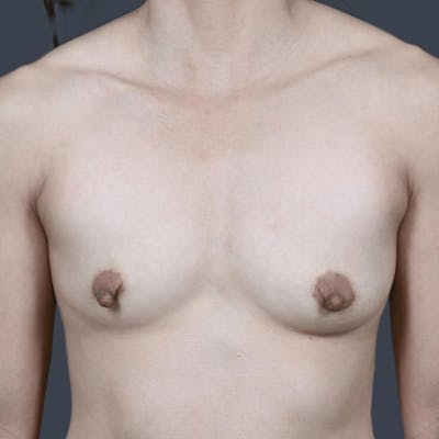 Breast Augmentation Before & After Gallery - Patient 351888 - Image 1