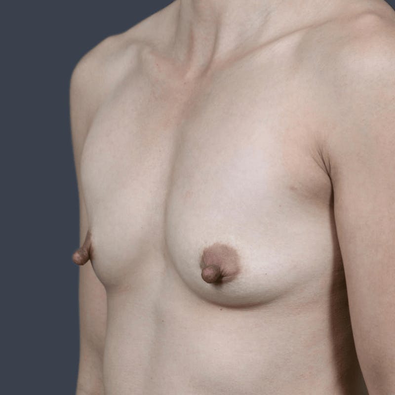 Breast Augmentation Before & After Gallery - Patient 351888 - Image 5