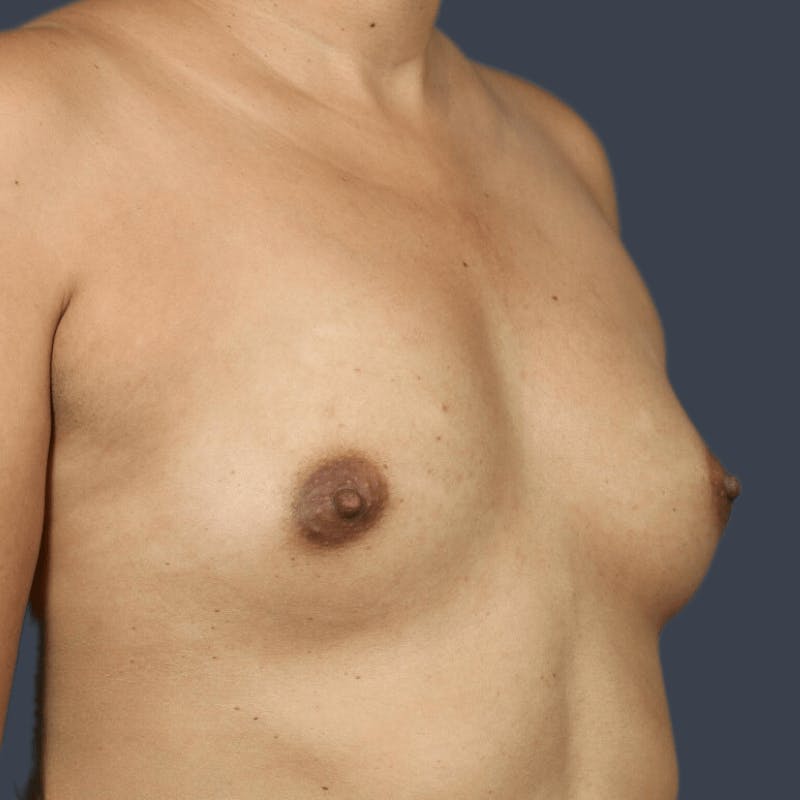 Breast Augmentation Before & After Gallery - Patient 418313 - Image 3