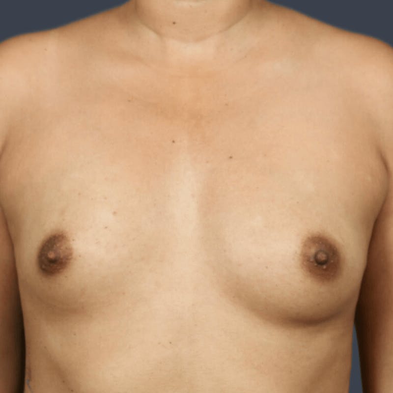 Breast Augmentation Before & After Gallery - Patient 418313 - Image 1