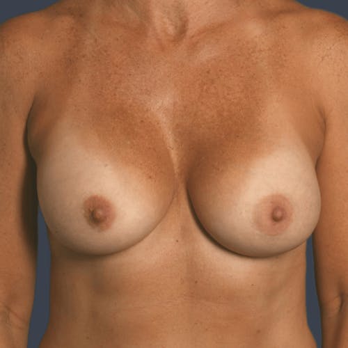 After procedure image for Breast Augmentation