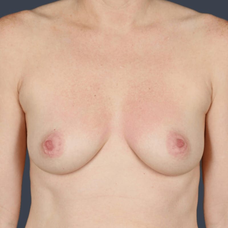 Breast Augmentation Before & After Gallery - Patient 868849 - Image 1