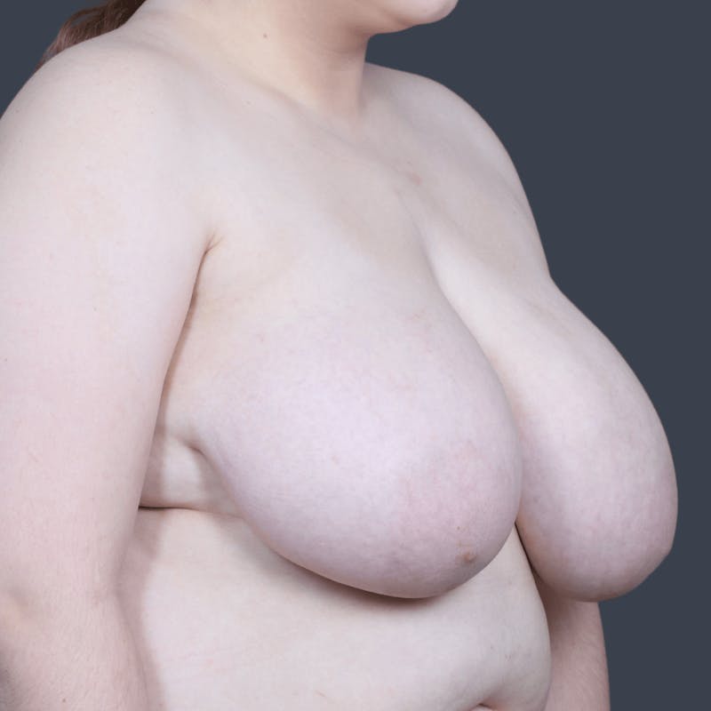 Breast Reduction Before & After Gallery - Patient 557757 - Image 3