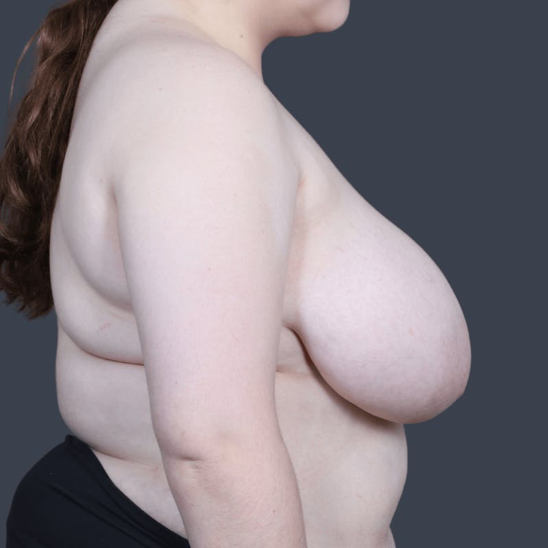 Breast Reduction Before & After Gallery - Patient 557757 - Image 5