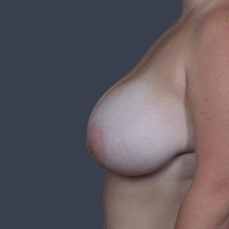 Breast Reduction Before & After Gallery - Patient 255277 - Image 5
