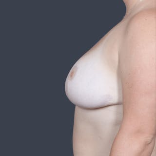 Breast Reduction Before & After Gallery - Patient 255277 - Image 6